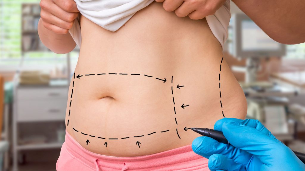 Liposuction
